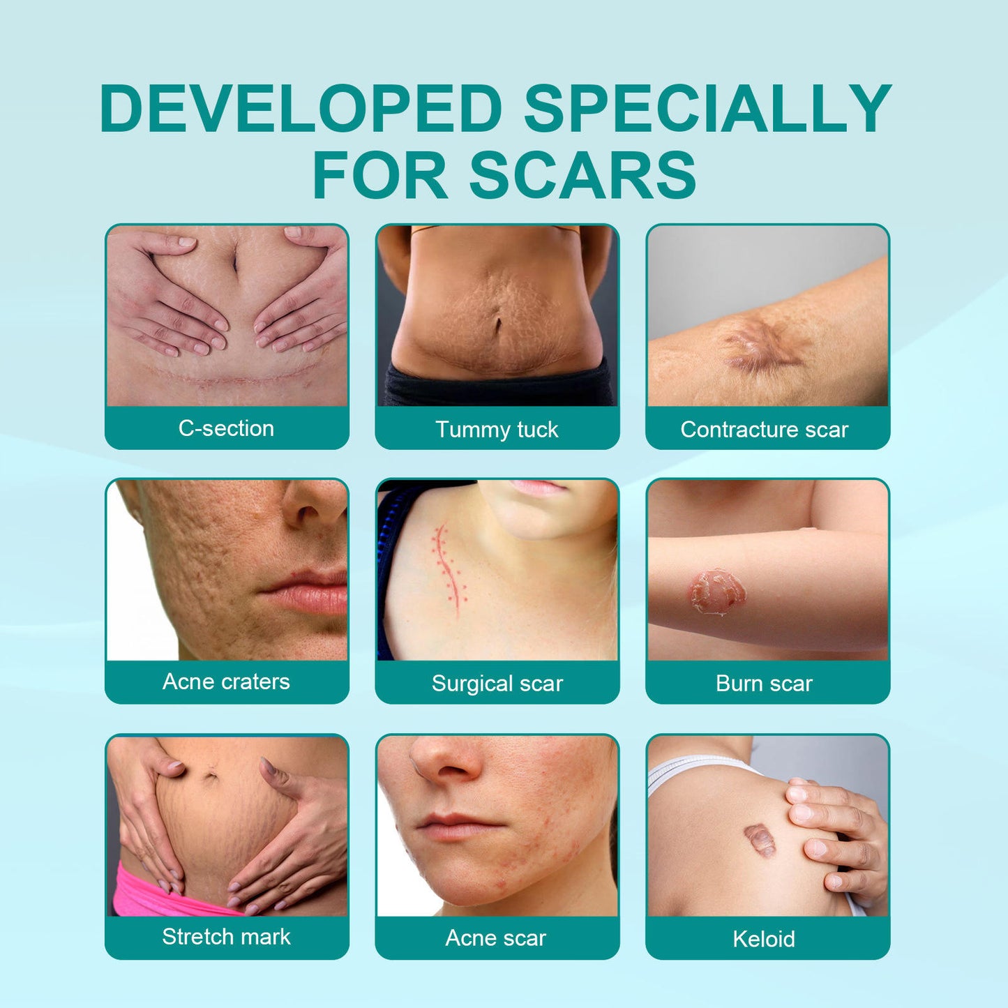 ✨ Regain Your Confidence – Fade Scars Fast with South Moon Medical Grade Scar Spray!