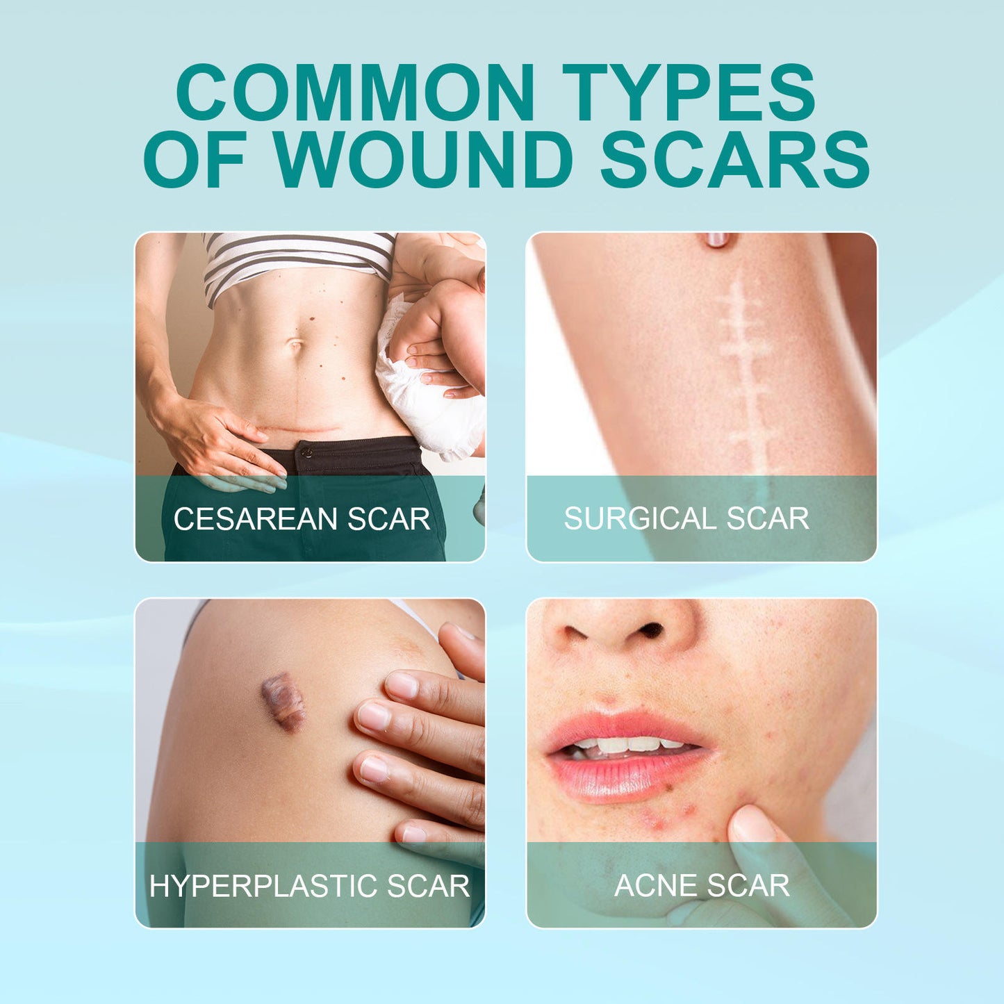 ✨ Regain Your Confidence – Fade Scars Fast with South Moon Medical Grade Scar Spray!